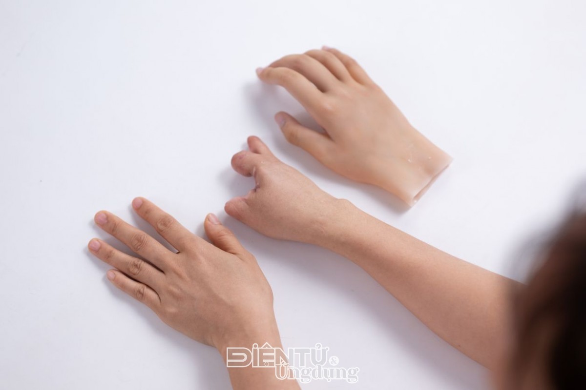 Phục hình thẩm mỹ silicone ‘made in Vietnam’, cơ hội mới cho người khuyết tật