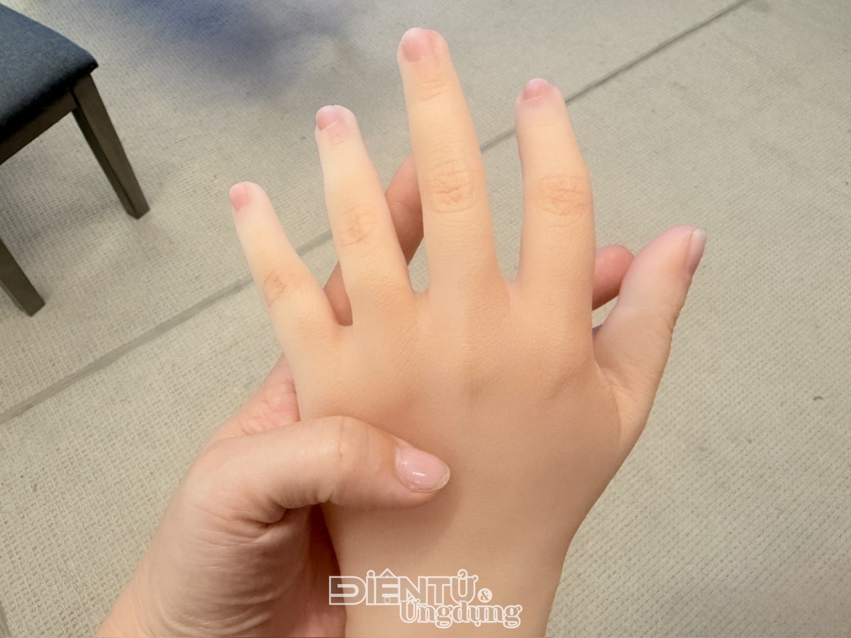 Phục hình thẩm mỹ silicone ‘made in Vietnam’, cơ hội mới cho người khuyết tật