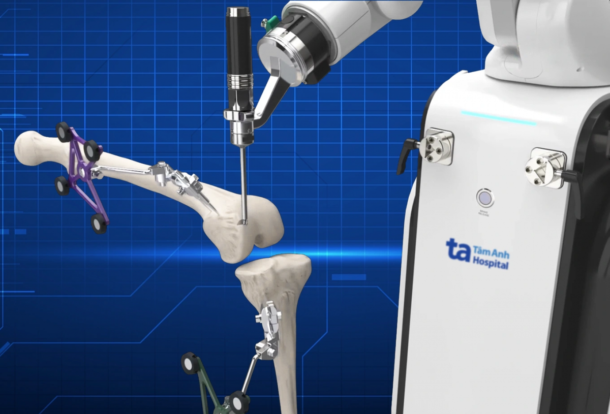 Robot CUVIS-Joint – hệ thống phẫu thuật thay khớp chủ động với độ chính xác cao từng milimet