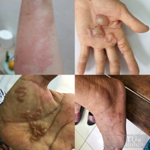 Bệnh nhân dễ lầm tưởng mắc bệnh da liễu, dị ứng khi bị ngứa, lở loét